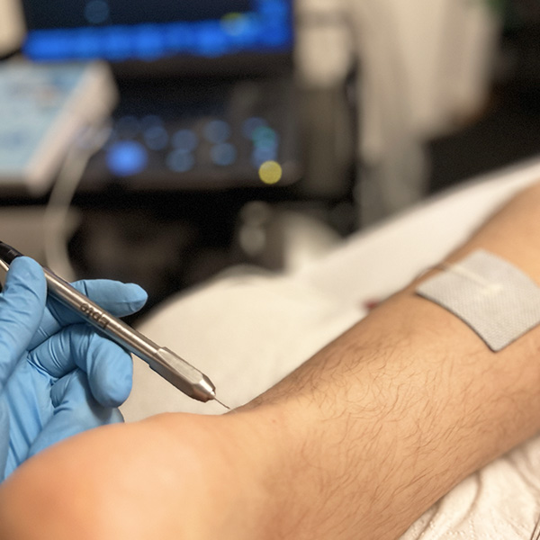 Terapia Przezskórnej Elektrolizy przy podglądzie USG